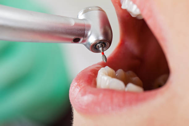 Best Emergency Root Canal Treatment in Nashville, AR